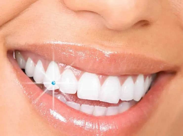 Biżuteria nazębna jak zrobić: krok po kroku do pięknego uśmiechu